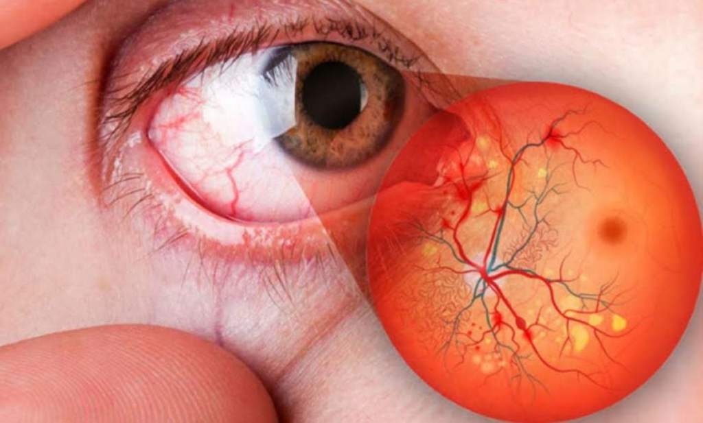 #Veracruz Alerta IMSS sobre retinopatía&nbsp;diabética