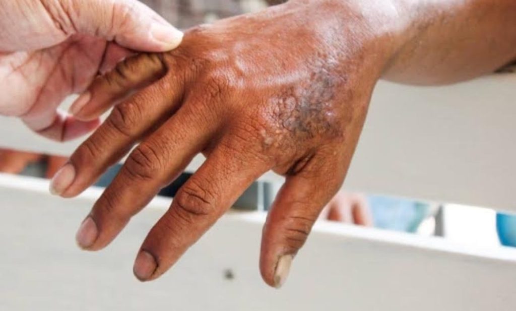 #Veracruz Recomienda IMSS evitar estigma social respecto a&nbsp;lepra